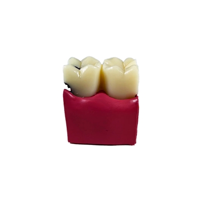 Стоматологическая модель зуба с кариесом и здоровым зубом Corpo Caries-4